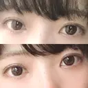 二重埋没 / 上まぶたの脂肪取り 東京ヒルズクリニック 新宿院 DAY 60 サムネイル用