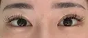 目頭切開 / 目尻切開 / タレ目形成・グラマラスライン（切開） EMMA CLINIC（エマクリニック） AFTER サムネイル用