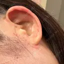 切開リフト GRACY TOKYO CLINIC【グレイシートウキョウクリニック】 DAY 31 サムネイル用