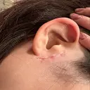 切開リフト GRACY TOKYO CLINIC【グレイシートウキョウクリニック】 DAY 31 サムネイル用