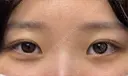 クマ治療 ネビュラクリニック 京都院 AFTER サムネイル用