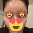 ヒアルロン酸注入（涙袋） / ヒアルロン酸注入（頬） / ヒアルロン酸注入（こめかみ） PRISM Beauty Clinic 新宿院 DAY 1 サムネイル用