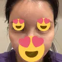 ヒアルロン酸注入（涙袋） / ヒアルロン酸注入（頬） / ヒアルロン酸注入（こめかみ） PRISM Beauty Clinic 新宿院 AFTER サムネイル用