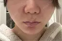 鼻翼基部形成（貴族手術） 新宿ラクル美容外科クリニック 新宿院 DAY 1 サムネイル用