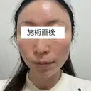 白玉点滴・注射 / ピコレーザートーニング（美白・肝斑） ライズワン美容皮膚科クリニック AFTER サムネイル用