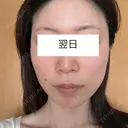白玉点滴・注射 / ピコレーザートーニング（美白・肝斑） ライズワン美容皮膚科クリニック DAY 1 サムネイル用