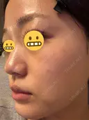 ピーリング（ニキビ・毛穴） / ピコレーザートーニング（美白・かんぱん） おおかみ美容のクリニック 新宿院 AFTER サムネイル用