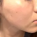 ピコレーザートーニング（美白・肝斑） / フラクショナルレーザー（毛穴・ニキビ跡） ルラ美容クリニック 京都院 DAY 4 サムネイル用