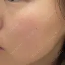 ピコレーザートーニング（美白・肝斑） / フラクショナルレーザー（毛穴・ニキビ跡） ルラ美容クリニック 京都院 DAY 10 サムネイル用