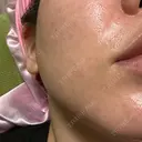 肌育注射（ジュベルックなど） Natural Skin Clinic 自由ヶ丘院 AFTER サムネイル用