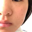 ピコレーザートーニング（美白・肝斑） / フラクショナルレーザー（毛穴・ニキビ跡） ルラ美容クリニック 京都院 DAY 16 サムネイル用