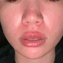 美肌レーザー / レーザーフェイシャル / 赤み除去レーザー AI Beauty Clinic （エーアイ美容クリニック） AFTER サムネイル用