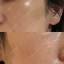 イオン導入 / ピーリング（ハリ・ツヤ） / ルメッカ ルラ美容クリニック 福岡本院 AFTER サムネイル用