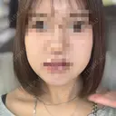 ボトックス（エラ・小顔） AYANAフィラーズクリニック 渋谷院 DAY 1 サムネイル用