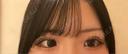 二重埋没 アリエル美容クリニック 郡山院 DAY 6 サムネイル用