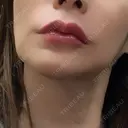 ヒアルロン酸注入（唇） / ボトックス（額） / ピーリング（ニキビ・毛穴） ルラ美容クリニック 札幌大通り院 DAY 0 サムネイル用