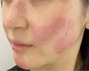 シミ取りレーザー / LDM・インテンスウルトラ Wi Clinic （ウィ クリニック）心斎橋院 DAY 0 サムネイル用