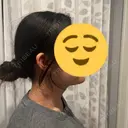 脂肪吸引（顔） 4Dクリニック AFTER サムネイル用