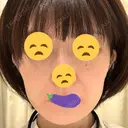 切開リフト GRACY TOKYO CLINIC【グレイシートウキョウクリニック】 AFTER サムネイル用