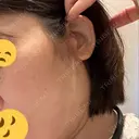 切開リフト GRACY TOKYO CLINIC【グレイシートウキョウクリニック】 DAY 36 サムネイル用