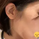切開リフト GRACY TOKYO CLINIC【グレイシートウキョウクリニック】 DAY 36 サムネイル用