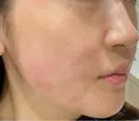 シミ取りレーザー / LDM・インテンスウルトラ Wi Clinic （ウィ クリニック）心斎橋院 DAY 1 サムネイル用