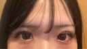 二重埋没 アリエル美容クリニック 郡山院 DAY 7 サムネイル用