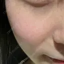 LDM・インテンスウルトラ Ledian Clinic六本木 DAY 3 サムネイル用