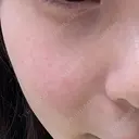 LDM・インテンスウルトラ Ledian Clinic六本木 DAY 1 サムネイル用
