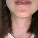 脂肪溶解注射（顔） Nクリニック伏見 AFTER サムネイル用
