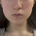 脂肪吸引（顔） 東京脂肪吸引クリニック AFTER サムネイル用