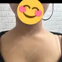 ボトックス（肩） DAILY SKIN CLINIC 福岡院 AFTER サムネイル用