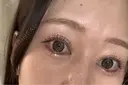 目頭切開 Brandnew Beauty Clinic AFTER サムネイル用