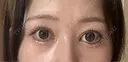 目頭切開 Brandnew Beauty Clinic DAY 523 サムネイル用