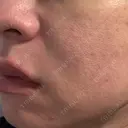 肌育注射（ジュベルックなど） / ニードルRF（ポテンツァなど） PureMe Skin Clinic（ピュアミースキンクリニック麻布） DAY 19 サムネイル用