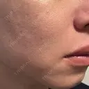 肌育注射（ジュベルックなど） / ニードルRF（ポテンツァなど） PureMe Skin Clinic（ピュアミースキンクリニック麻布） DAY 19 サムネイル用