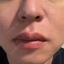 肌育注射（ジュベルックなど） / ニードルRF（ポテンツァなど） PureMe Skin Clinic（ピュアミースキンクリニック麻布） DAY 19 サムネイル用
