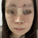 鼻尖形成（切開） / 鼻中隔延長（切開） / 軟骨移植 / 鼻尖縮小 / 鼻翼基部形成（貴族手術） ジョウクリニック 大阪院 DAY 1 サムネイル用