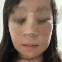 鼻尖形成（切開） / 鼻中隔延長（切開） / 軟骨移植 / 鼻尖縮小 / 鼻翼基部形成（貴族手術） ジョウクリニック 大阪院 DAY 2 サムネイル用