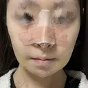 鼻尖形成（切開） / 鼻中隔延長（切開） / 軟骨移植 / 鼻尖縮小 / 鼻翼基部形成（貴族手術） ジョウクリニック 大阪院 DAY 3 サムネイル用