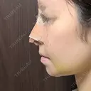鼻尖形成（切開） / 鼻中隔延長（切開） / 軟骨移植 / 鼻尖縮小 / 鼻翼基部形成（貴族手術） ジョウクリニック 大阪院 DAY 3 サムネイル用