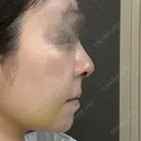 鼻尖形成（切開） / 鼻中隔延長（切開） / 軟骨移植 / 鼻尖縮小 / 鼻翼基部形成（貴族手術） ジョウクリニック 大阪院 DAY 7 サムネイル用