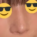 鼻尖形成（切開） / ワシ鼻修正・ハンプ切除 / 眉間プロテーゼ / 鼻柱下降・鼻唇角形成（猫手術） / ヒアルロン酸注入（額） グローバルビューティークリニック 大阪院 DAY 155 サムネイル用