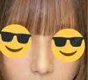 鼻尖形成（切開） / ワシ鼻修正・ハンプ切除 / 眉間プロテーゼ / 鼻柱下降・鼻唇角形成（猫手術） / ヒアルロン酸注入（額） グローバルビューティークリニック 大阪院 DAY 232 サムネイル用