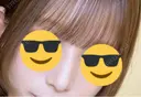 鼻尖形成（切開） / ワシ鼻修正・ハンプ切除 / 眉間プロテーゼ / 鼻柱下降・鼻唇角形成（猫手術） / ヒアルロン酸注入（額） グローバルビューティークリニック 大阪院 AFTER サムネイル用