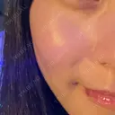 LDM・インテンスウルトラ Ledian Clinic六本木 DAY 5 サムネイル用