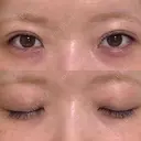 二重埋没 コスメディカルクリニック シンシア 銀座院 AFTER サムネイル用