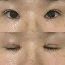 二重切開 / 目頭切開 EMMA CLINIC（エマクリニック） AFTER サムネイル用