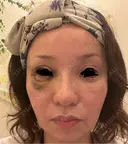 タレ目形成・グラマラスライン（埋没） Zetith Beauty Clinic 銀座院 DAY 7 サムネイル用