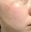 ルメッカ 仙台TAクリニック DAY 2 サムネイル用